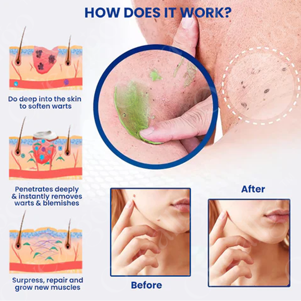 ✅ Official Store: Oveallgo™ NatureErase Pro Instant Mole & Spot Cream