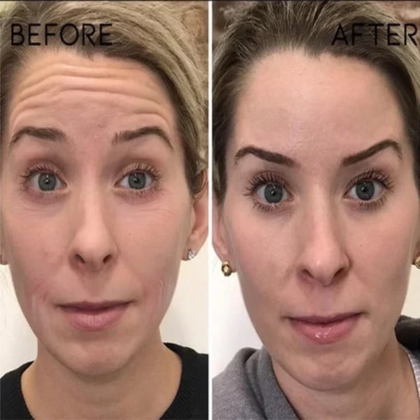 🔥Last Day Promotion 70% OFF🔥-Botox Face Serum