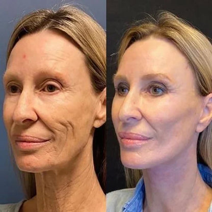 🔥Last Day Promotion 70% OFF🔥-Botox Face Serum