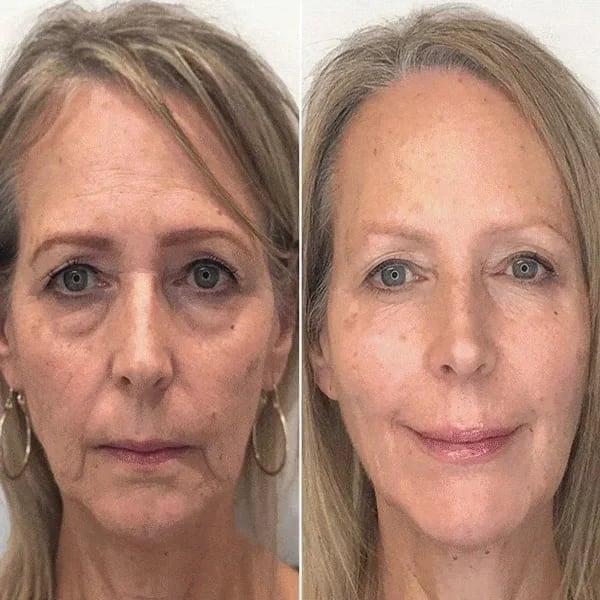 🔥Last Day Promotion 70% OFF🔥-Botox Face Serum