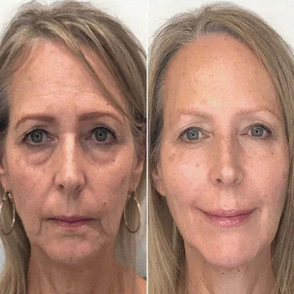 🔥Last Day Promotion 70% OFF🔥-Botox Face Serum