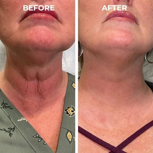 🔥Last Day Promotion 70% OFF🔥-Botox Face Serum